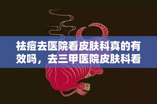 祛痘去医院看皮肤科真的有效吗，去三甲医院皮肤科看痘痘大约多少钱